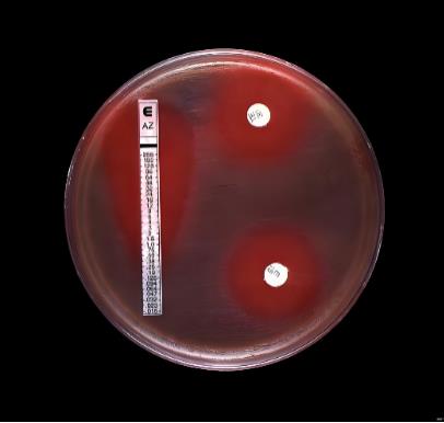 高通量药敏检测指导儿童急性白血病个体化治疗的初步探索——摘要、资料与方法